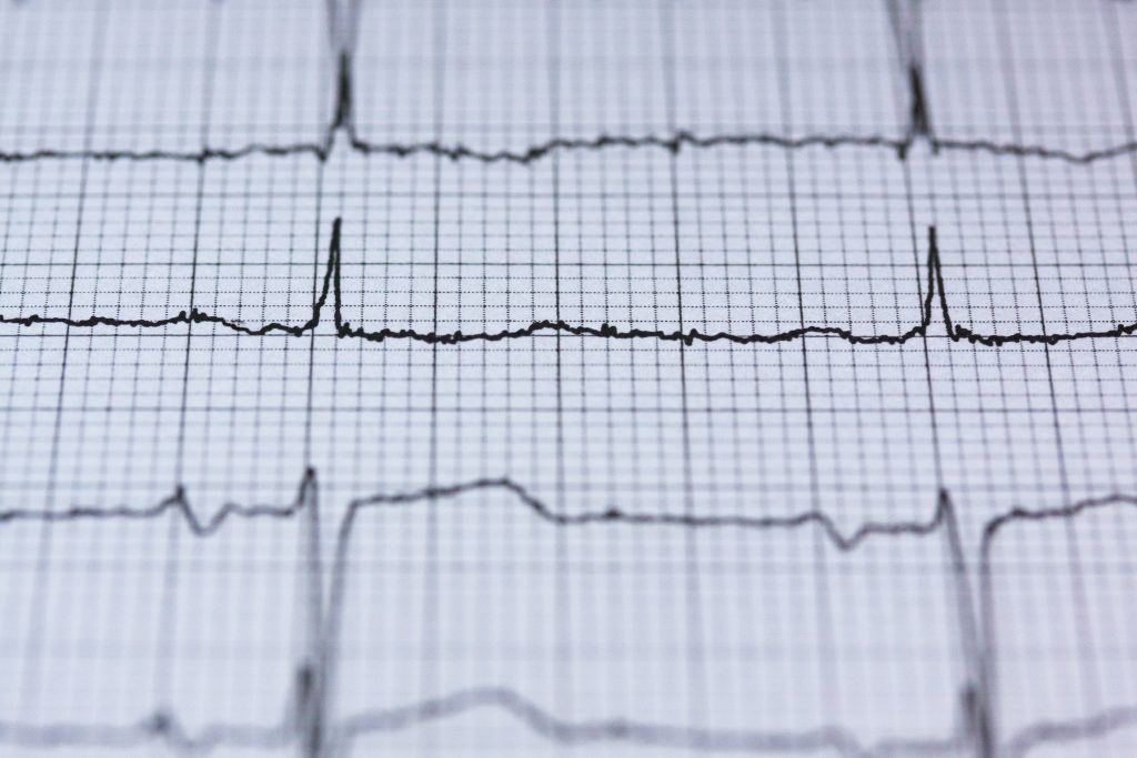 Tachycardia