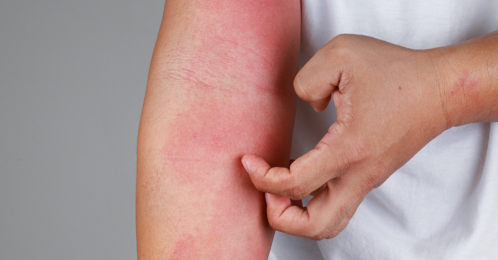 Eczema: What You Need To Know